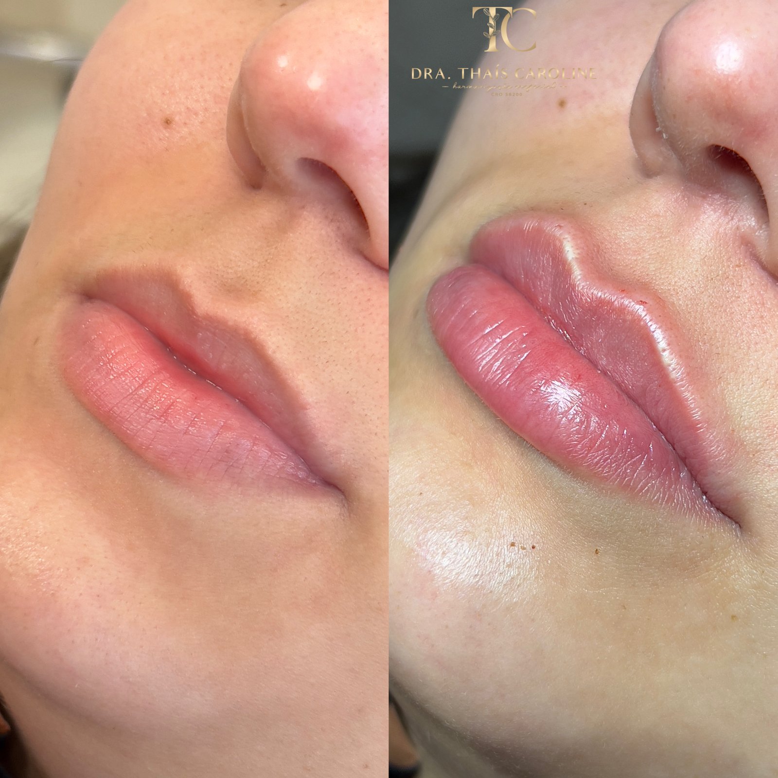 Resultado antes e depois da metodologia Construindo Lábios